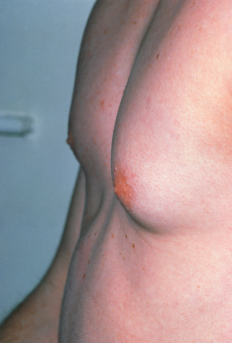 Male affected by gynaecomastia (enlarged breast)