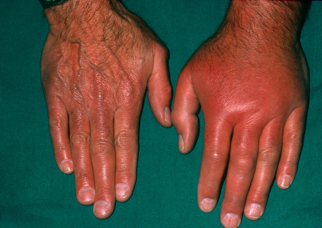 The hand of a patient affected by gout