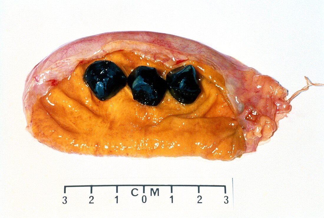 Excised gall bladder opened to show 3 gall stones