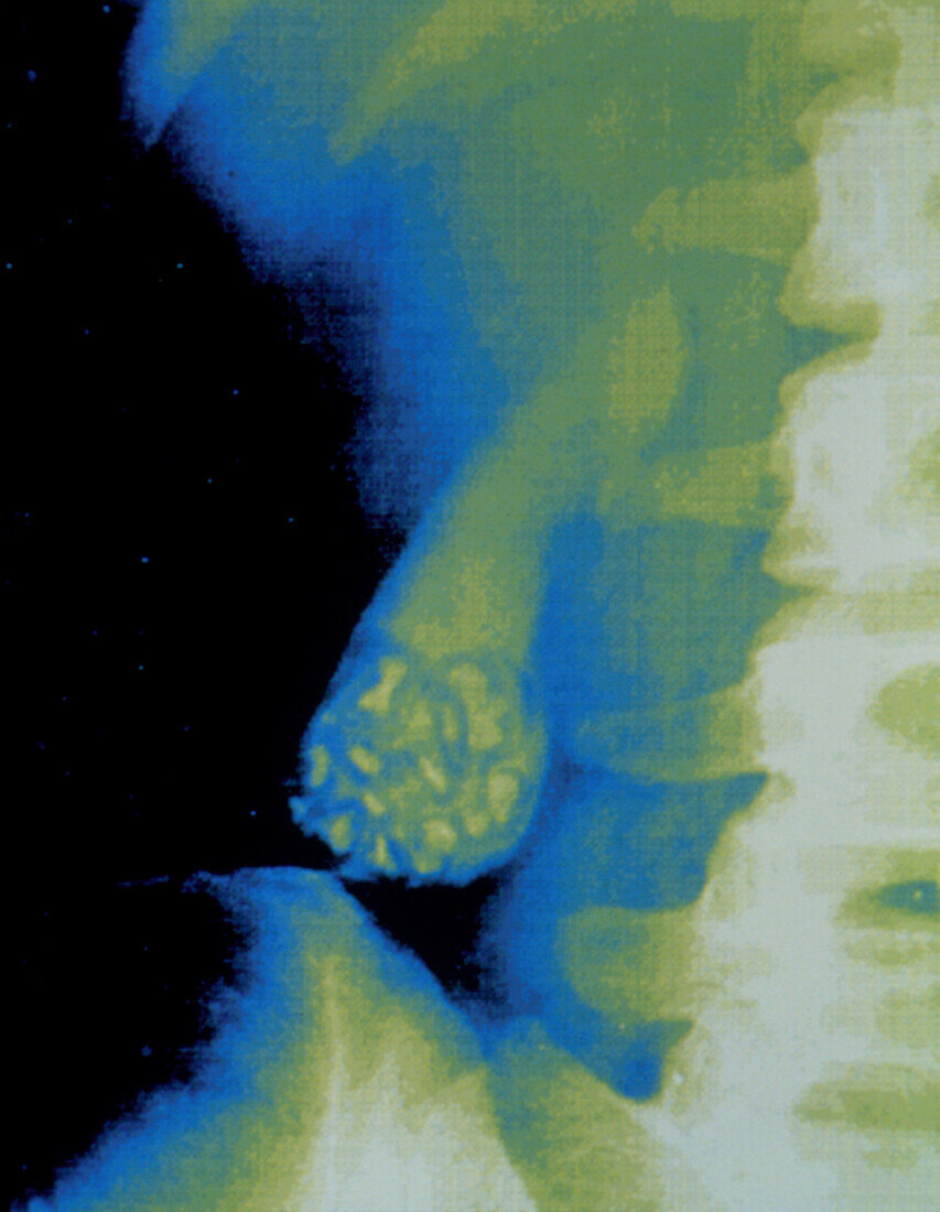 Coloured X-ray showing gallstones in gall bladder