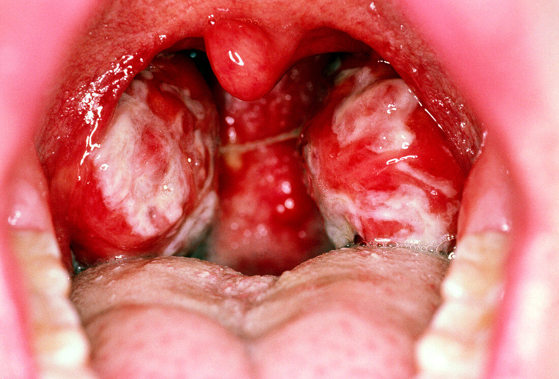 Tonsils of person with glandular fever