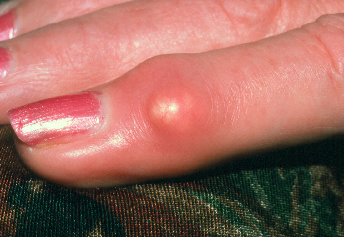 Inflamed finger joint in woman with gout
