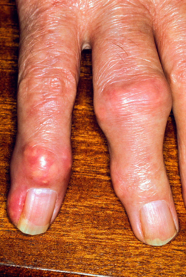 Tophi due to gout on fingers of patient