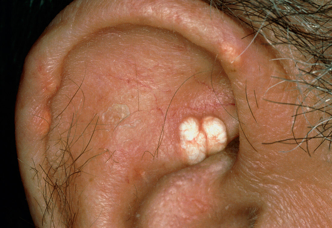 Tophi due to gout on ear of patient
