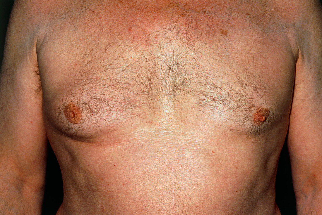 Gynaecomastia: enlarged breast in elderly man