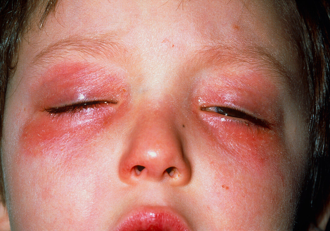Allergic conjunctivitis
