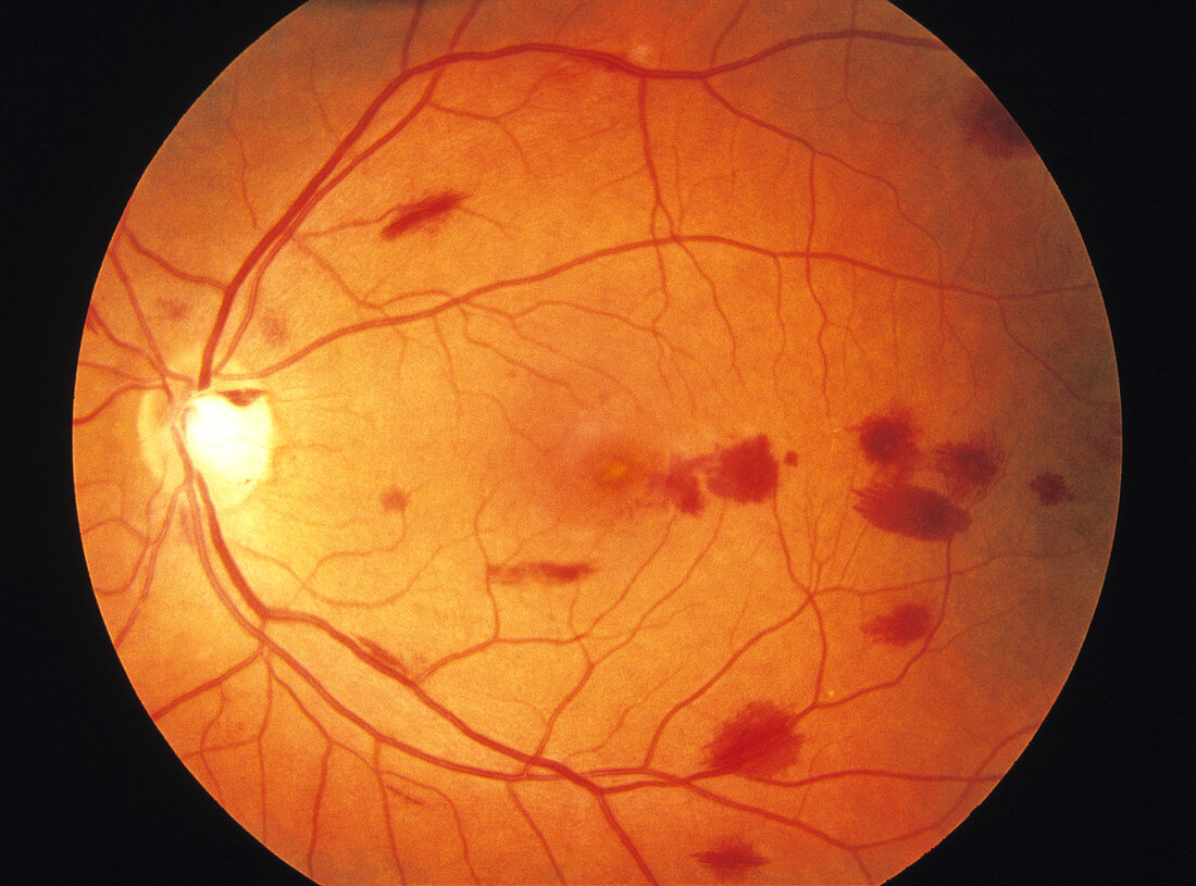 Retina damage in leukaemia