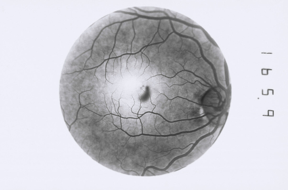 Retinal blood vessel disorder