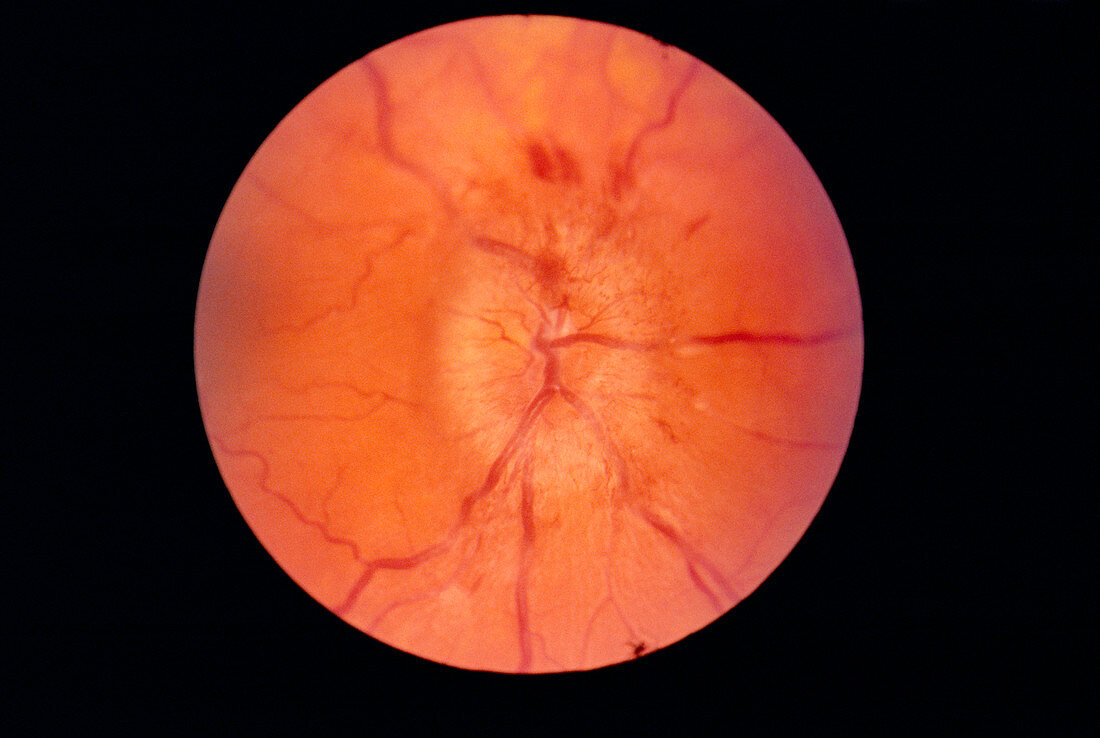 Papilloedema of the eye