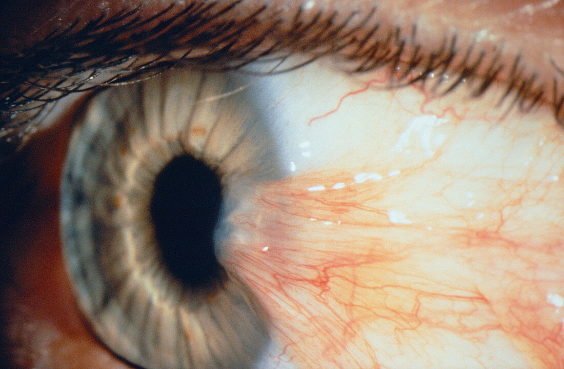 Pterygium of the eye