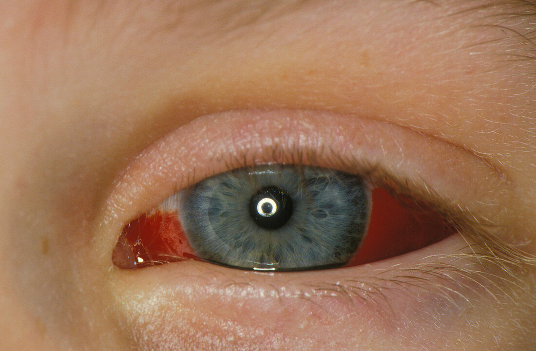 Bleeding in eye