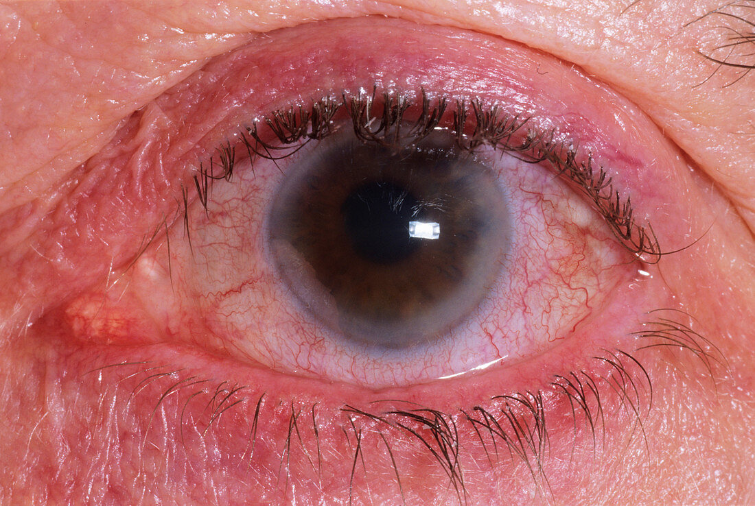Glaucoma of the eye