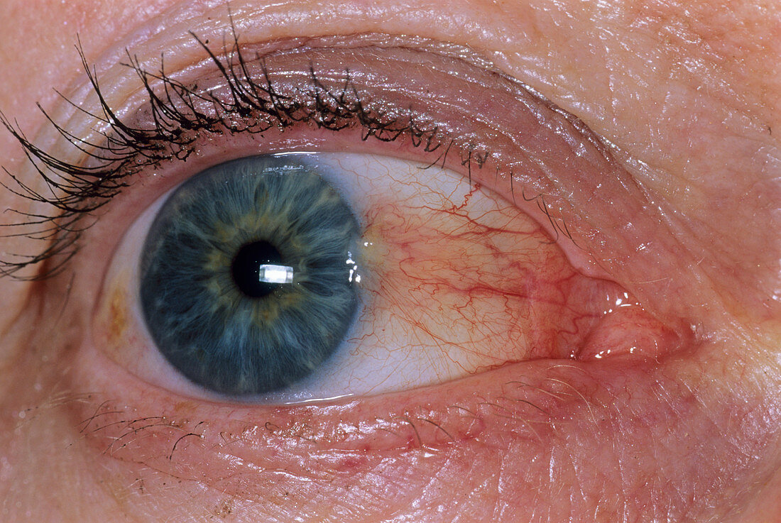 Pterygium