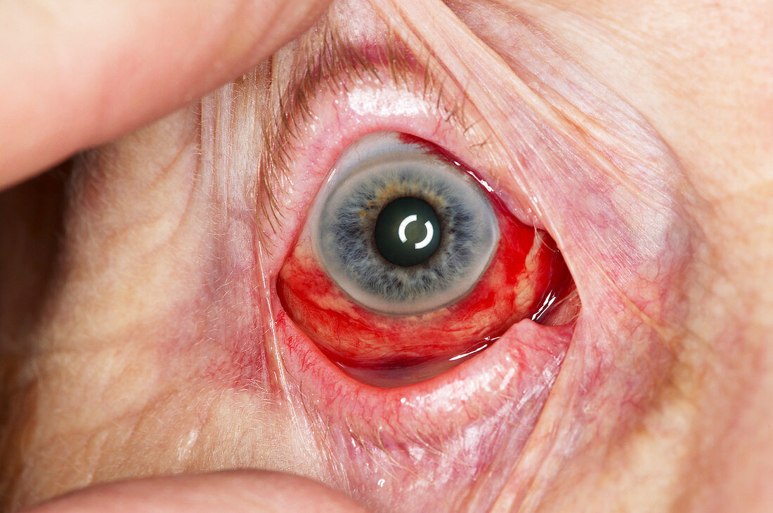 Bleeding in the eye