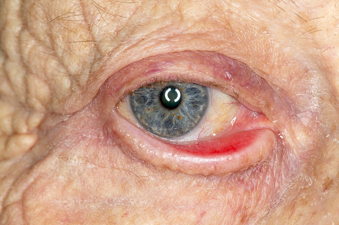Ectropion (dropping eyelid) of the eye
