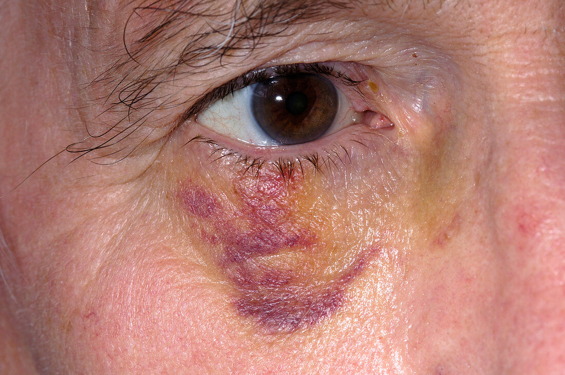 Post-op bruising of the eyelid