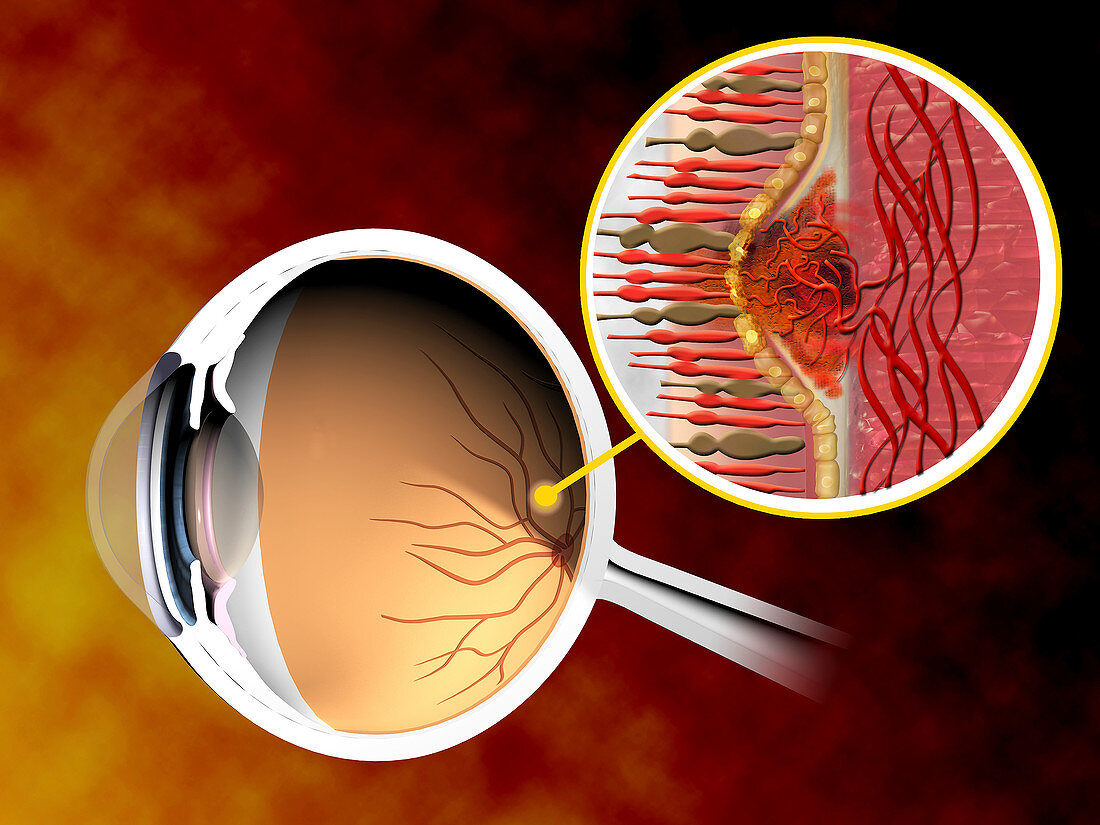 Illustration of macular degeneration