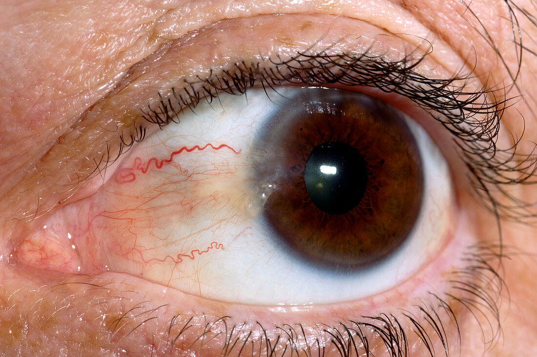 Pterygium eye disorder