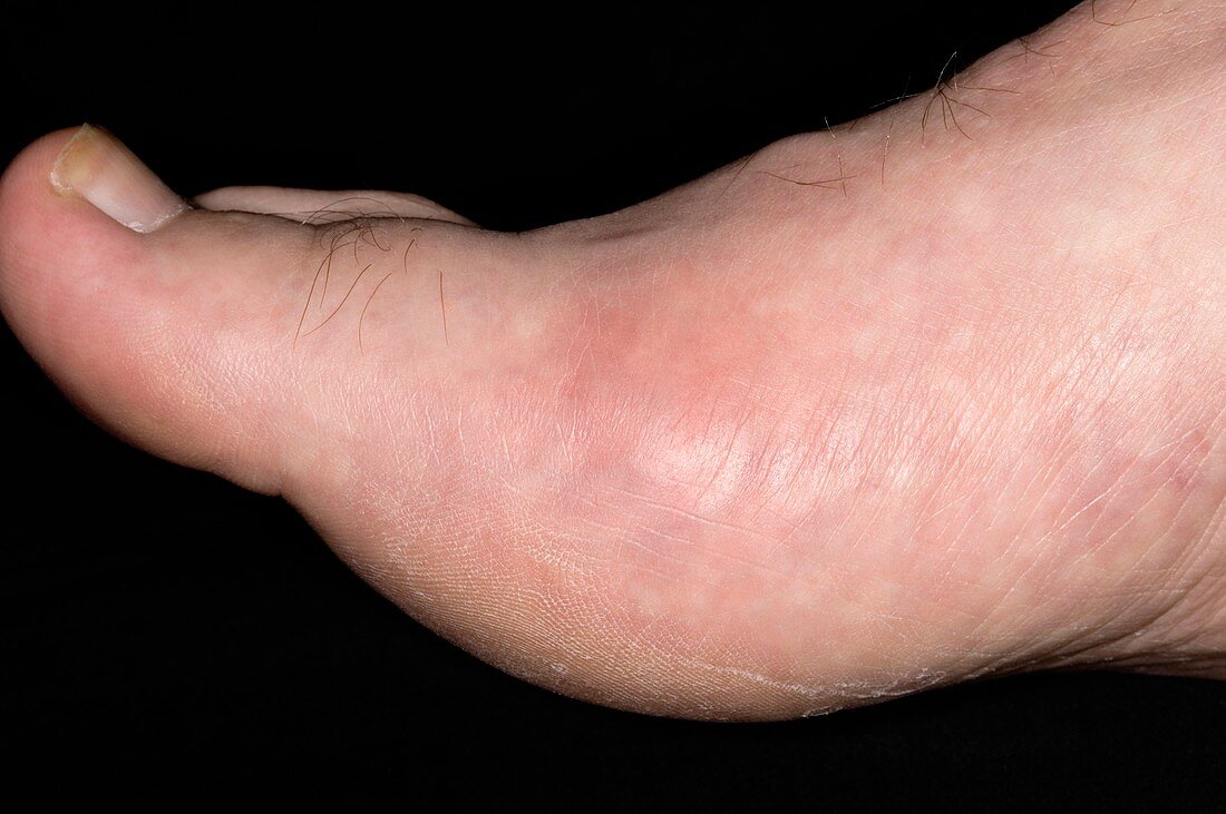 Gout of the big toe joint