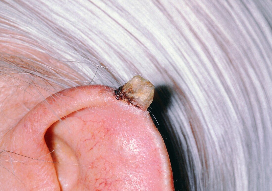 Cutaneous horn on ear