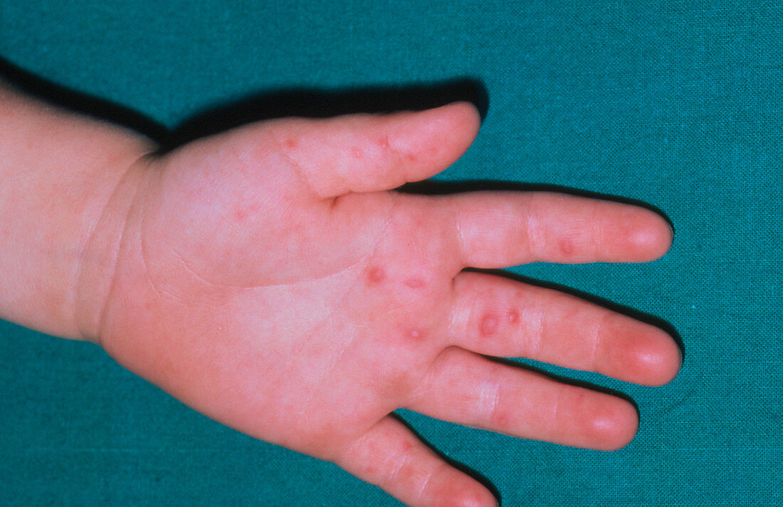 Hand,foot & mouth disease: skin lesions on hand