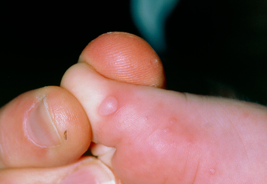 Hand,foot & mouth disease: lesion on toe