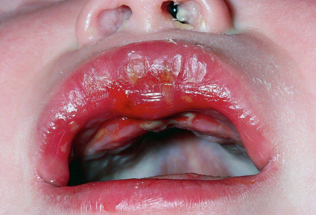 Close-up of baby's mouth with herpes simplex ulcer