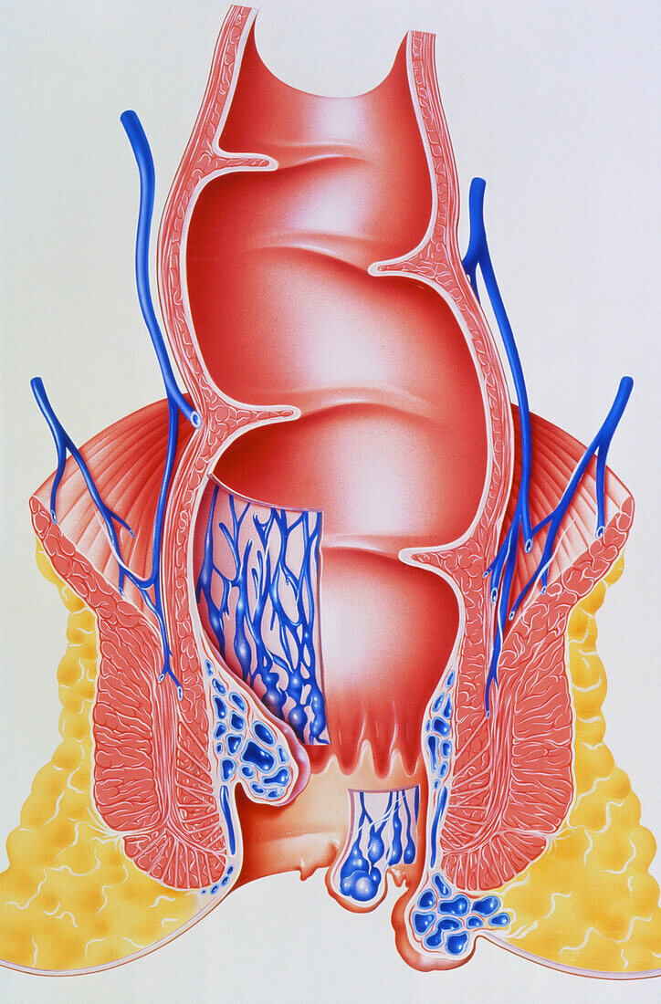 Artwork of section through anus with haemorrhoids
