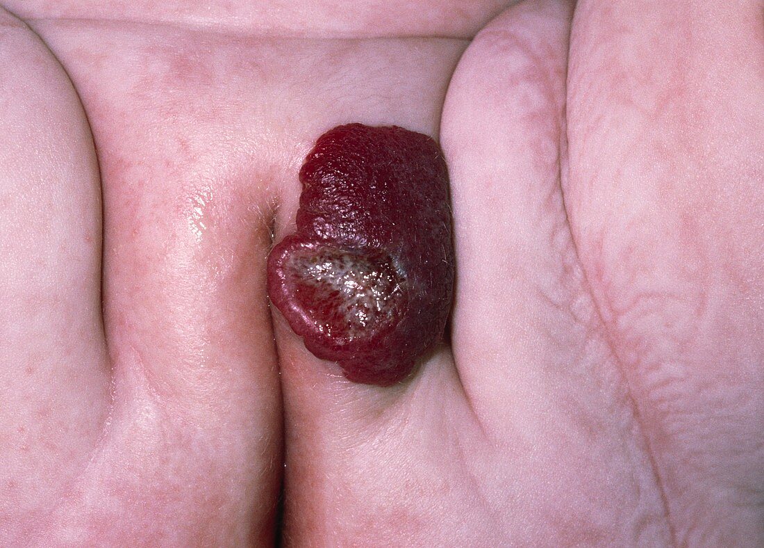Capillary haemangioma on the vulva of a child