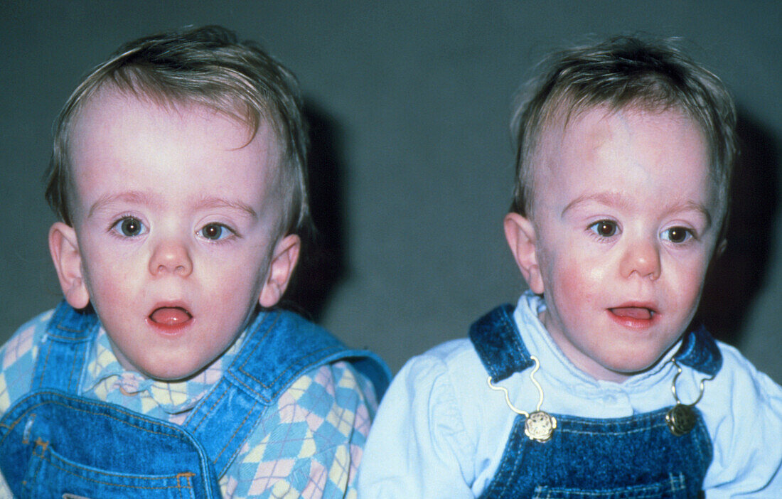 Twin boys (18-month-old) with hydrocephalus