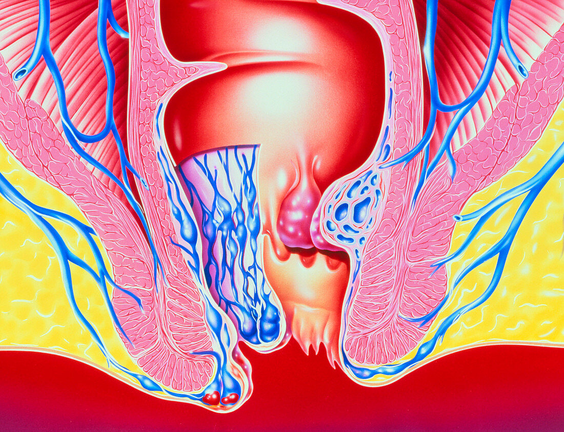 Artwork of section through anus with haemorrhoids