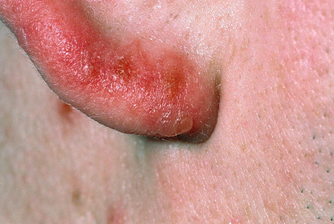 Lesions on ear due to hand,foot and mouth disease