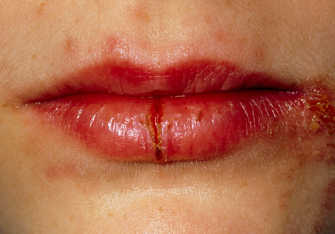 Cracked lips of girl affected by Herpes simplex