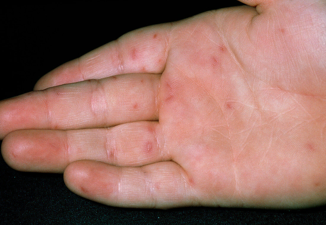 Lesions on hand due to hand,foot & mouth disease