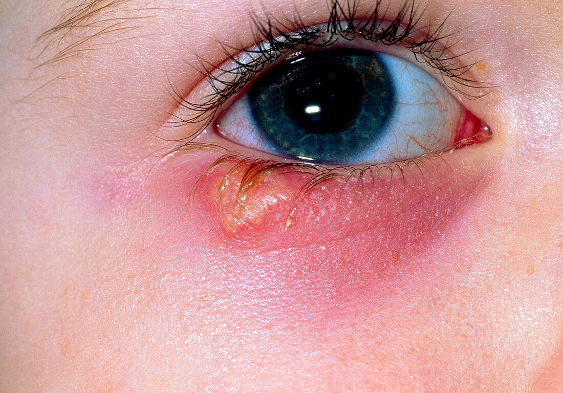 Herpes simplex blister below eye of young girl