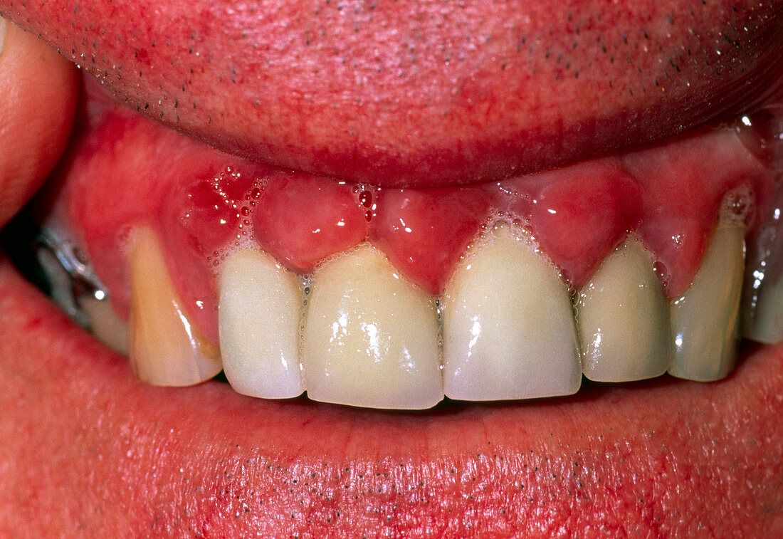 Hyperplasia of the gums due to the drug nifedipine