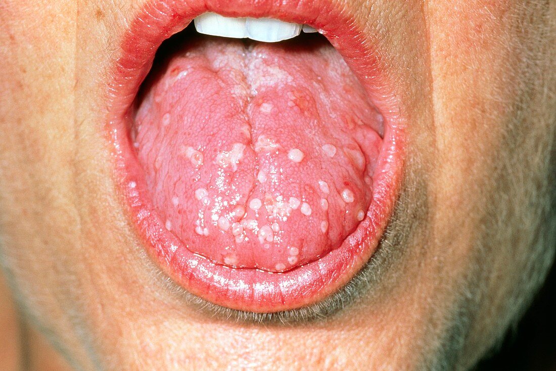 Tongue blisters due to the Herpes simplex virus