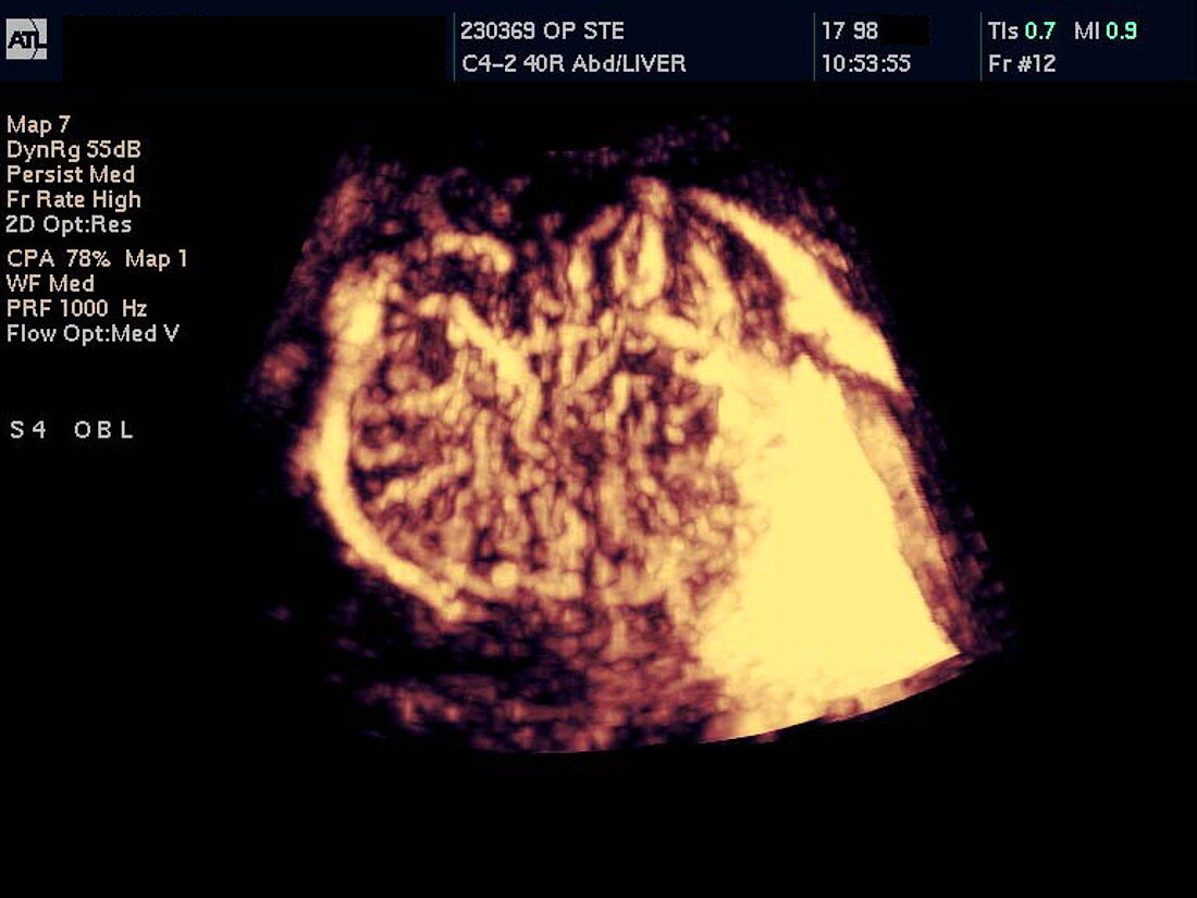 Liver tumour,3-D Doppler ultrasound