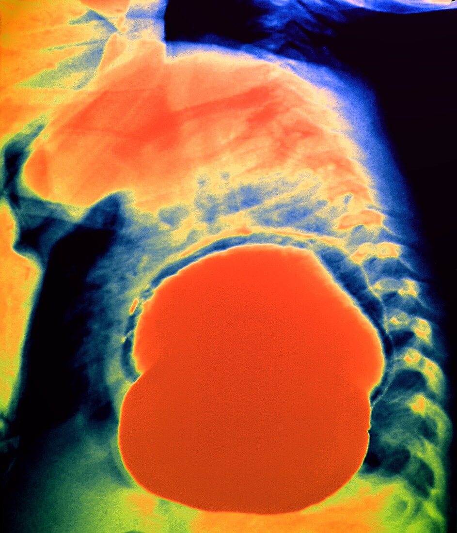 Hiatus hernia,X-ray