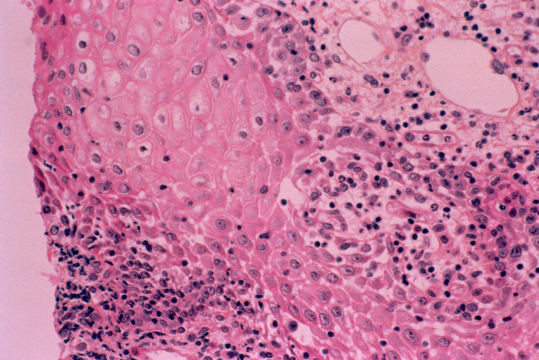 Herpes infection,light micrograph