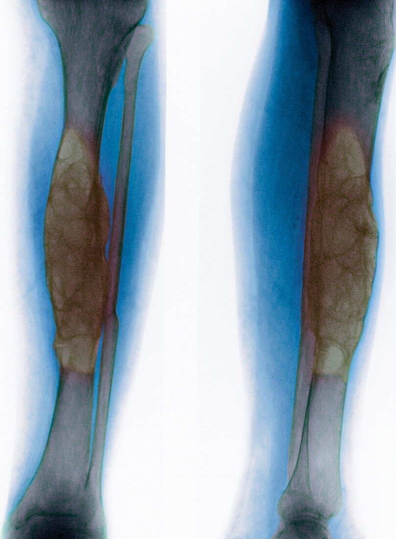 Brown tumours,X-ray