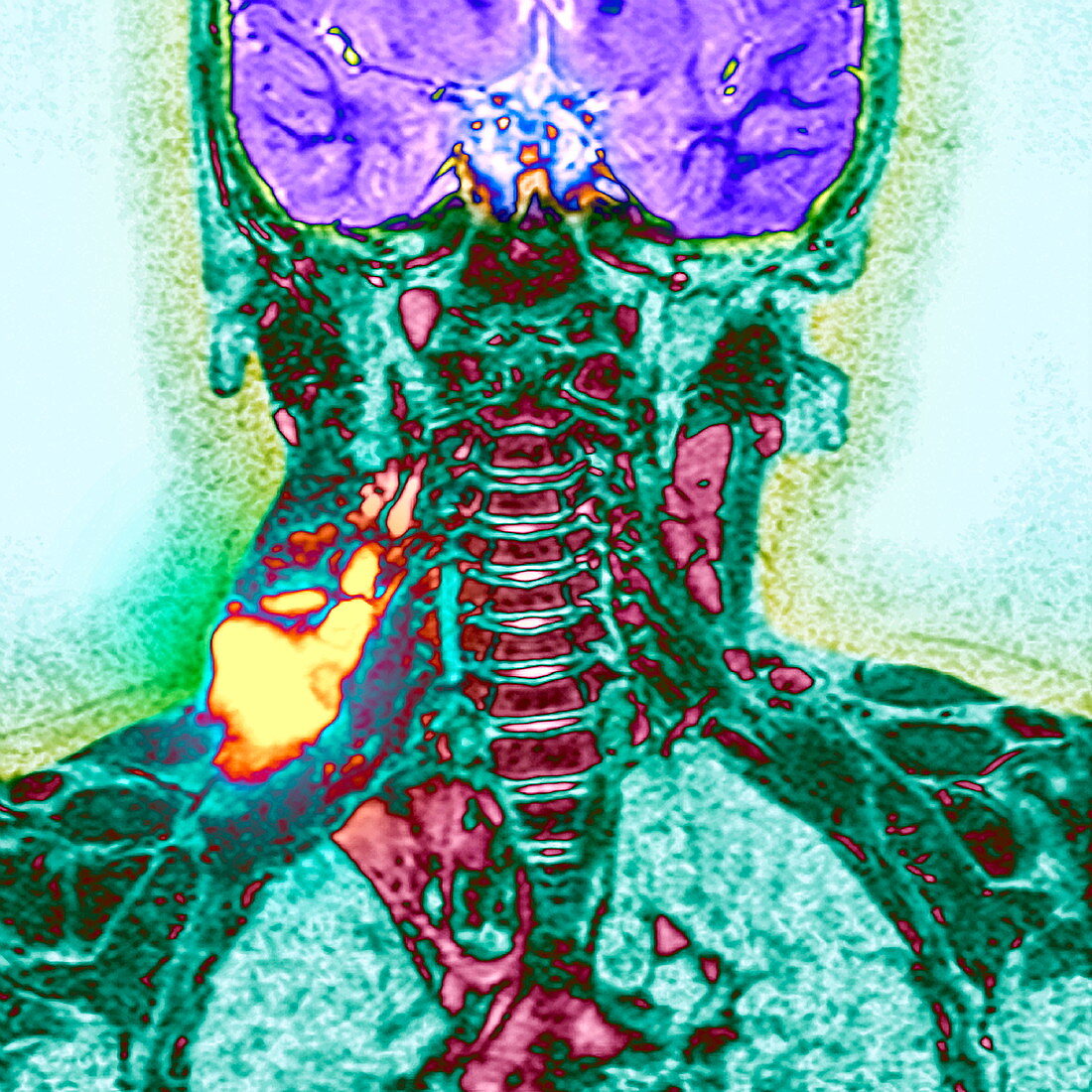 Cystic growth,MRI