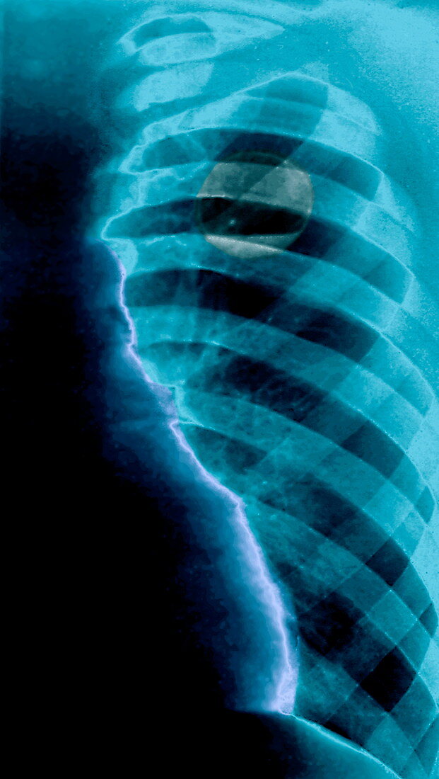 Hydropneumothorax,X-ray