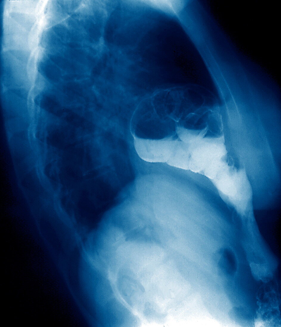 Morgagni hernia,X-ray