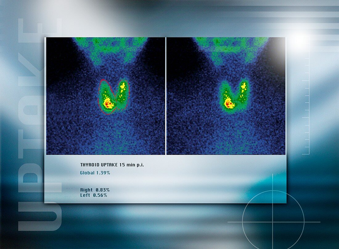 Hypothyroidism,gamma camera scan