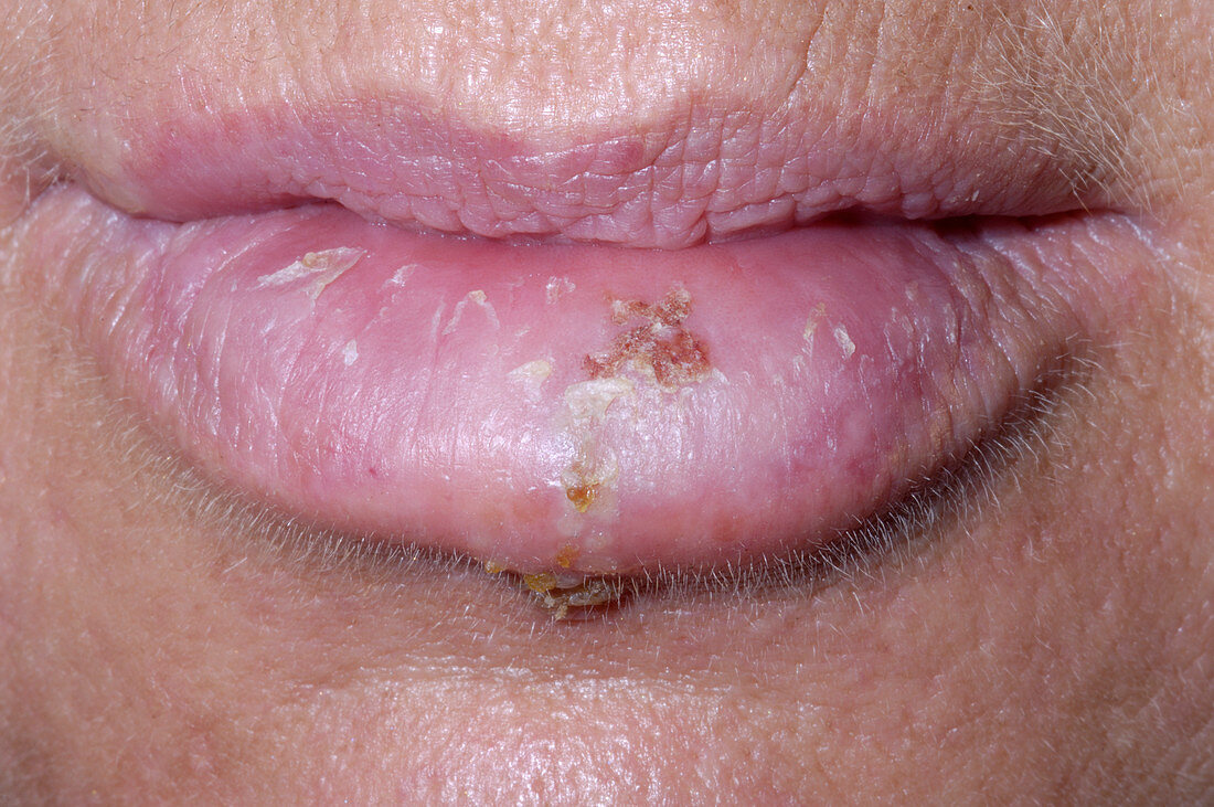 Cold sores (Herpes simplex) on the lips