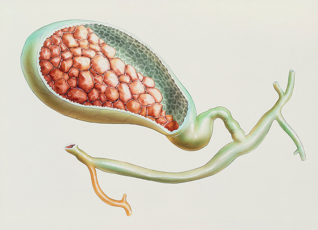 Artwork of gallstones in the gall bladder