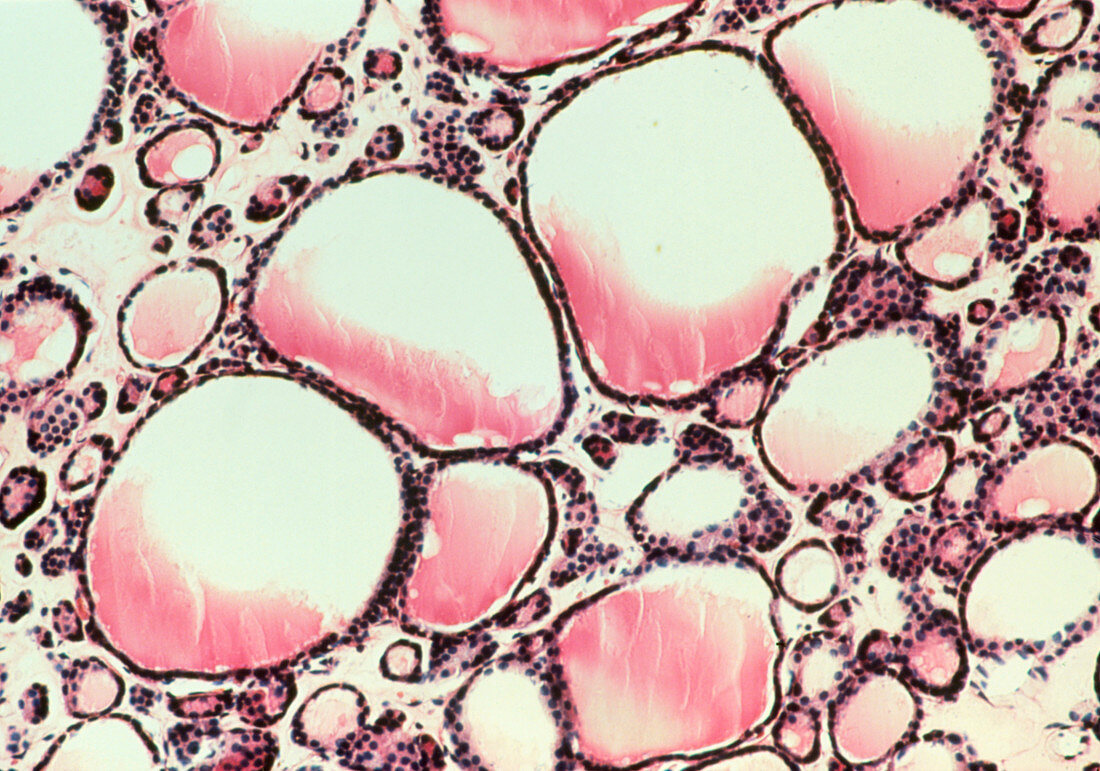 LM of follicles in a goitre-affected thyroid gland