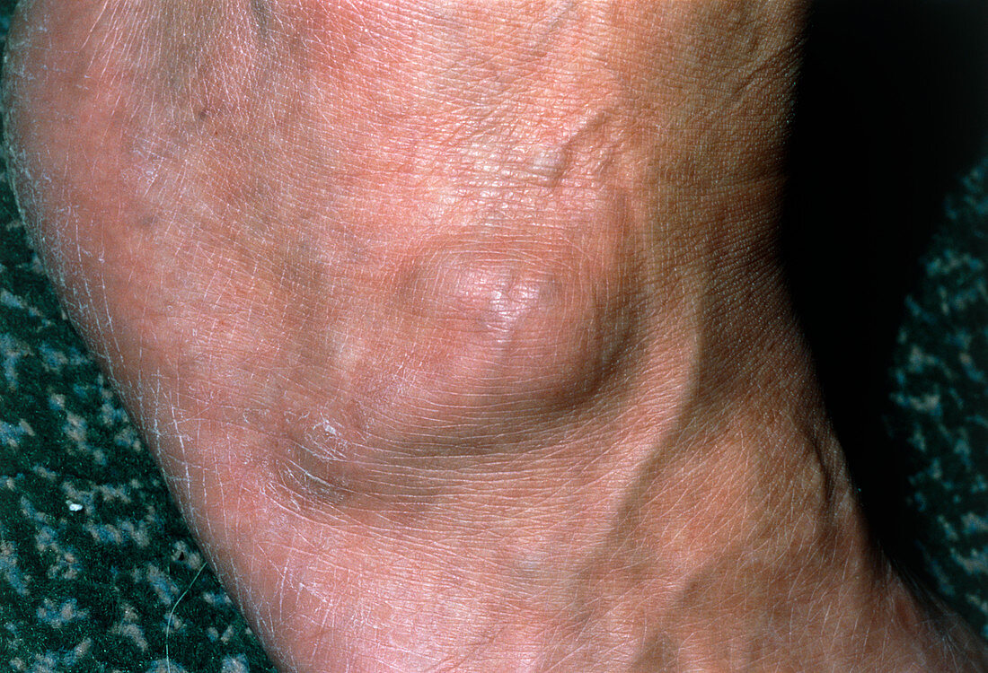 View of a ganglion found on the foot of a patient
