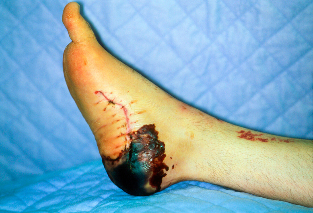 Close up of gangrene of a diabetic foot